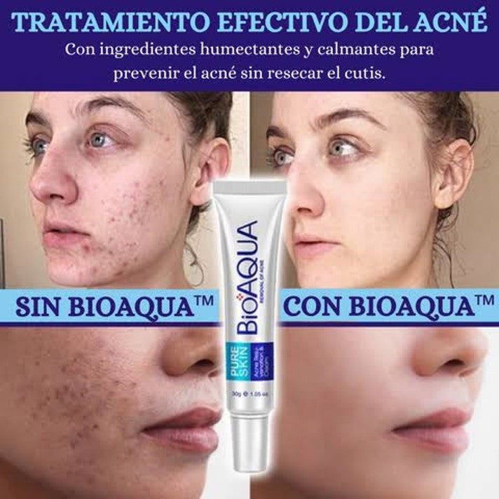 Crema anti-acné sin granos en el rostro